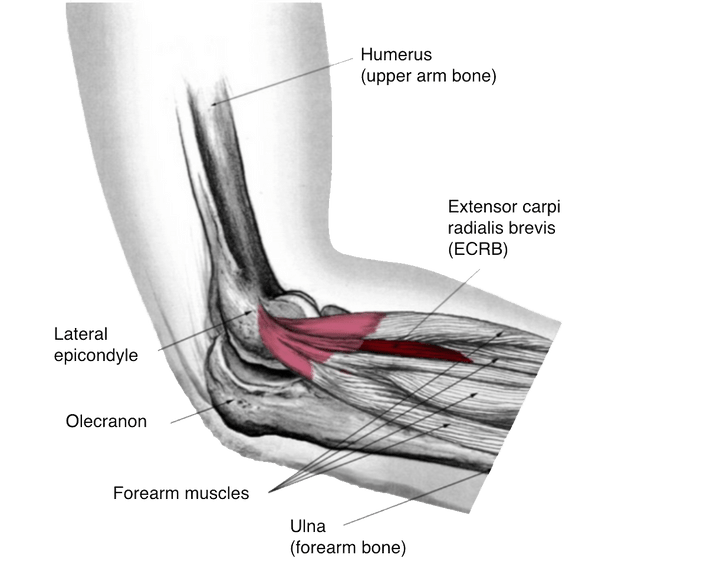 Tennis elbow treatment SportVis™