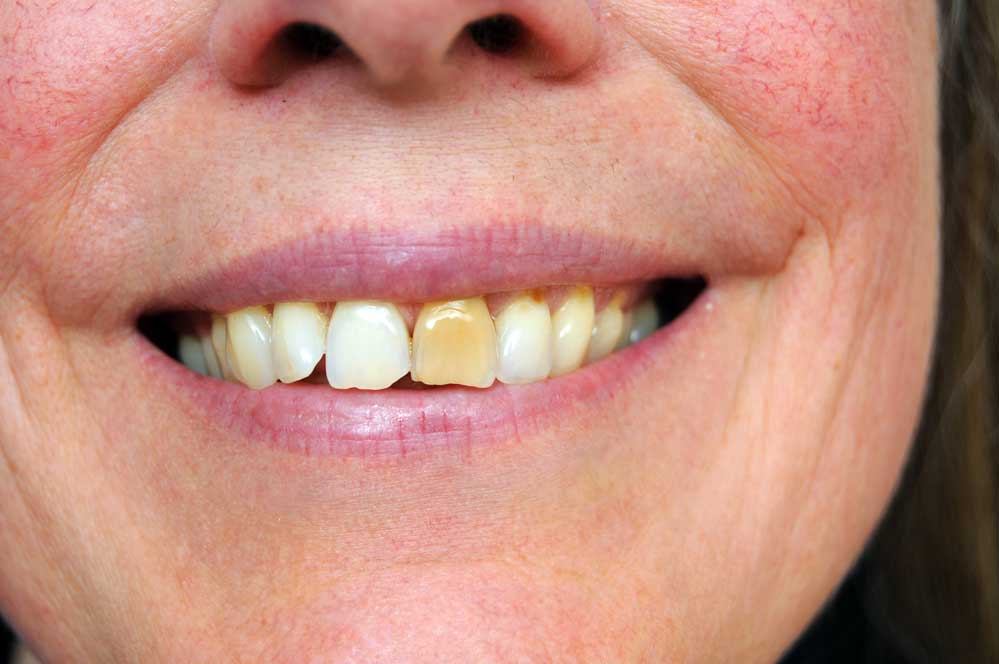 How Alcohol and Tobacco Affect Your Teeth Springdale