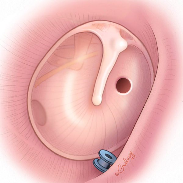 Medical & Surgical Conditions of the Ear Colorado