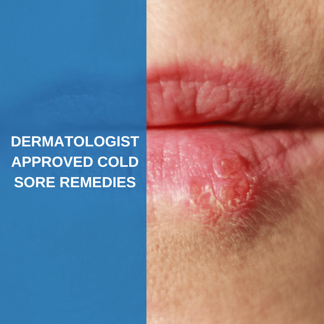 Dermatologist Approved Cold Sore Remedies Savannah River Dermatology