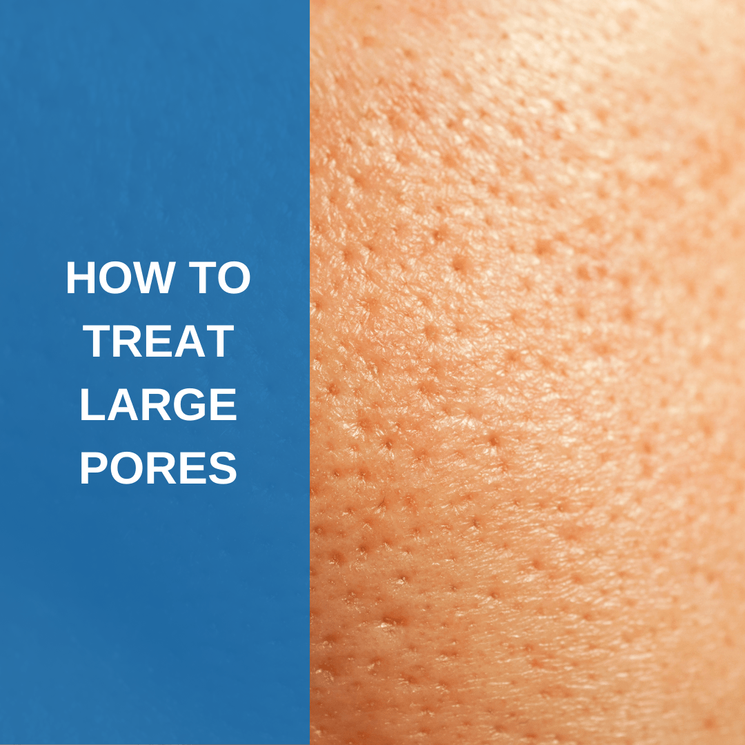 How To Treat Large Pores Savannah River Dermatology