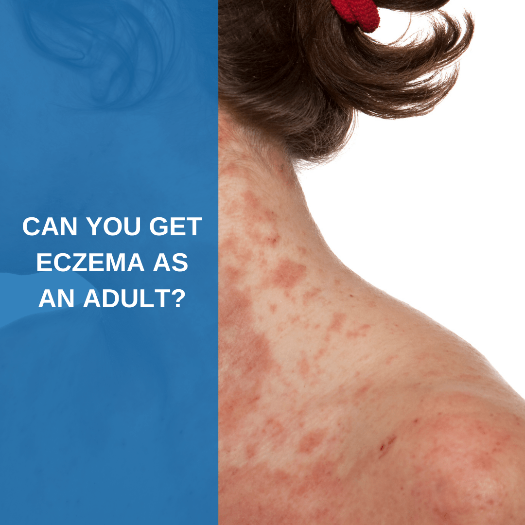 Can You Get Eczema as an Adult? Savannah River Dermatology