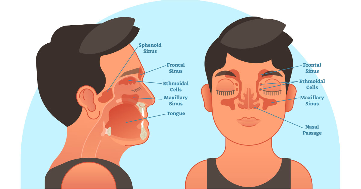 What happens if nasal polyps go untreated?