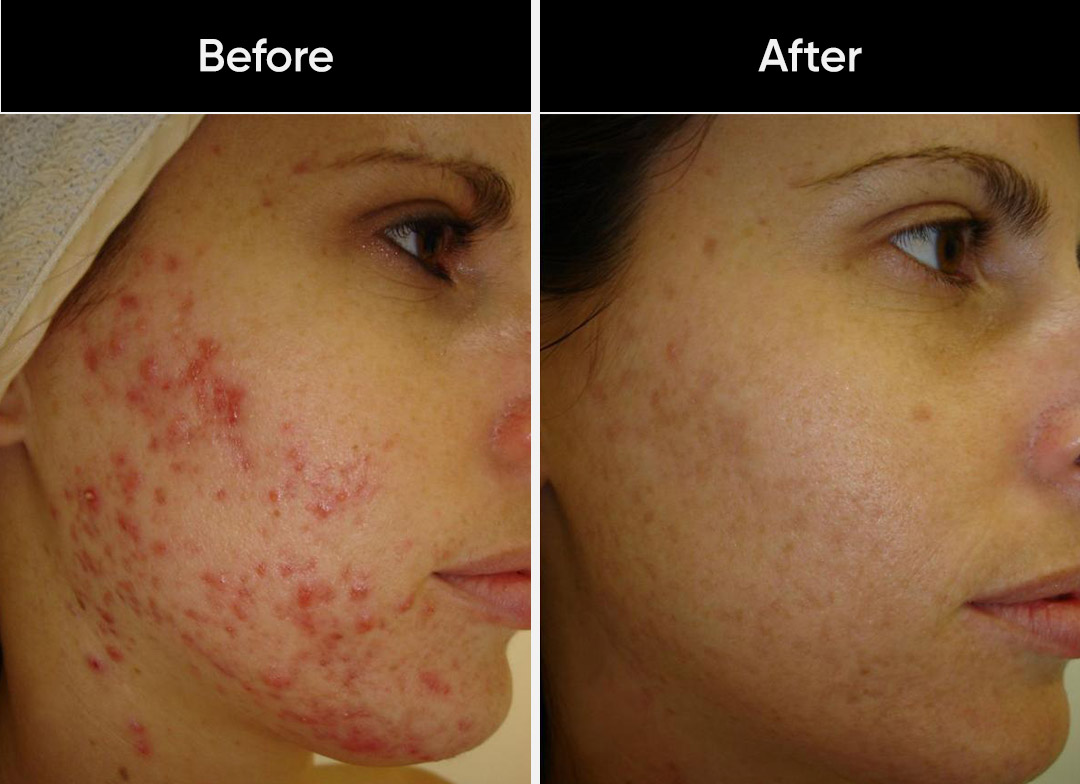 Acne & Cystic Acne Treatments in San Antonio at Stadia Med Spa
