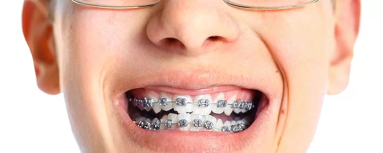 Problems with Your Braces St. Andrews Dental Cambridge, Ontario N1