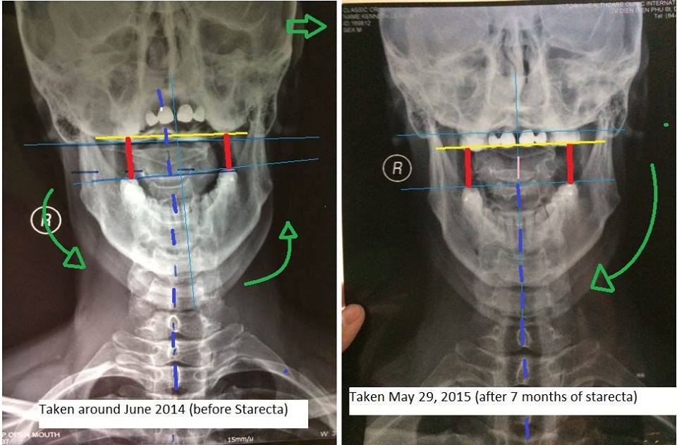Icd 10 Code For Neck Pain Radiating Into Upper Arm