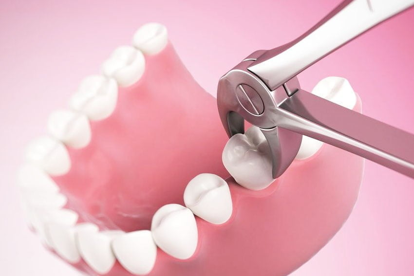 Tooth Extraction Starlight Dental Clinic