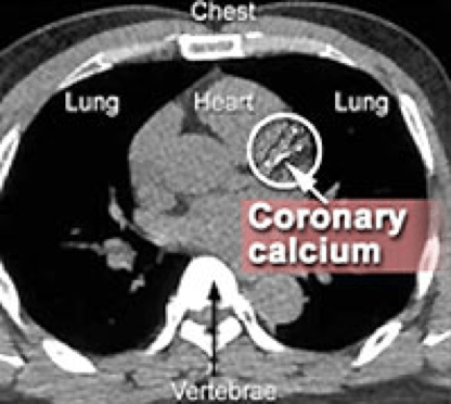 Coronary Calcium Scoring: The Most Advanced Screening Method To Determine Risk Of Heart Disease With Coronary Ct Scan - Starling Physicians