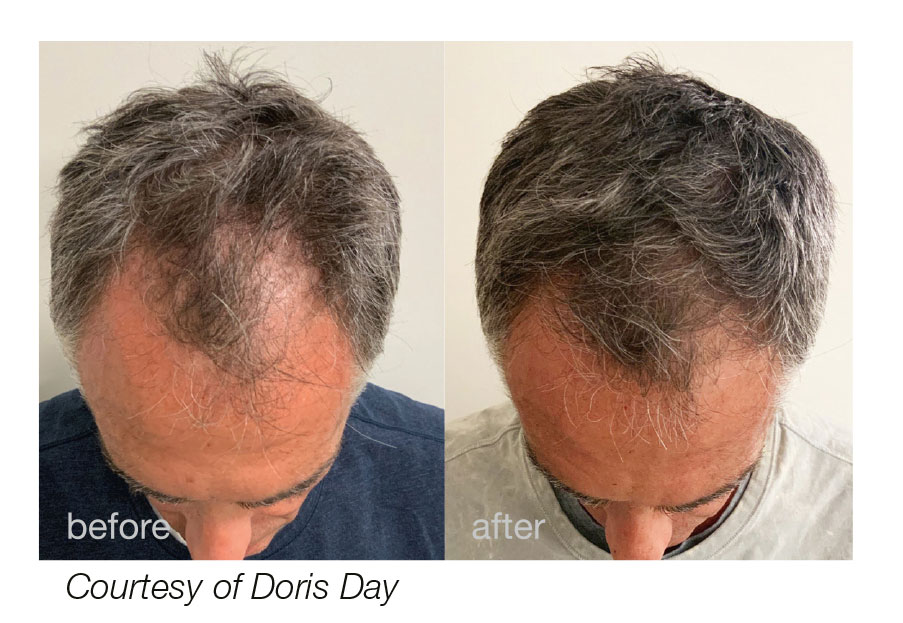 HAIRestart® Hair Restoration Indianapolis Starsiak Aesthetics