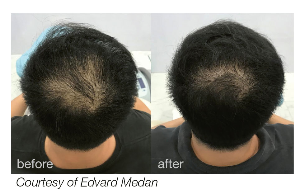 HAIRestart® Hair Restoration Indianapolis Starsiak Aesthetics