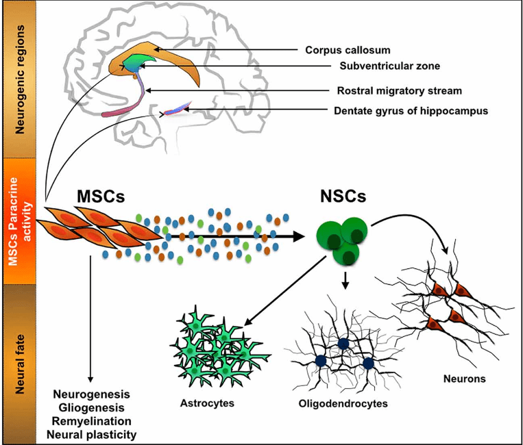 Parkinson Disease Treatment with Stem Cells Swiss Medica
