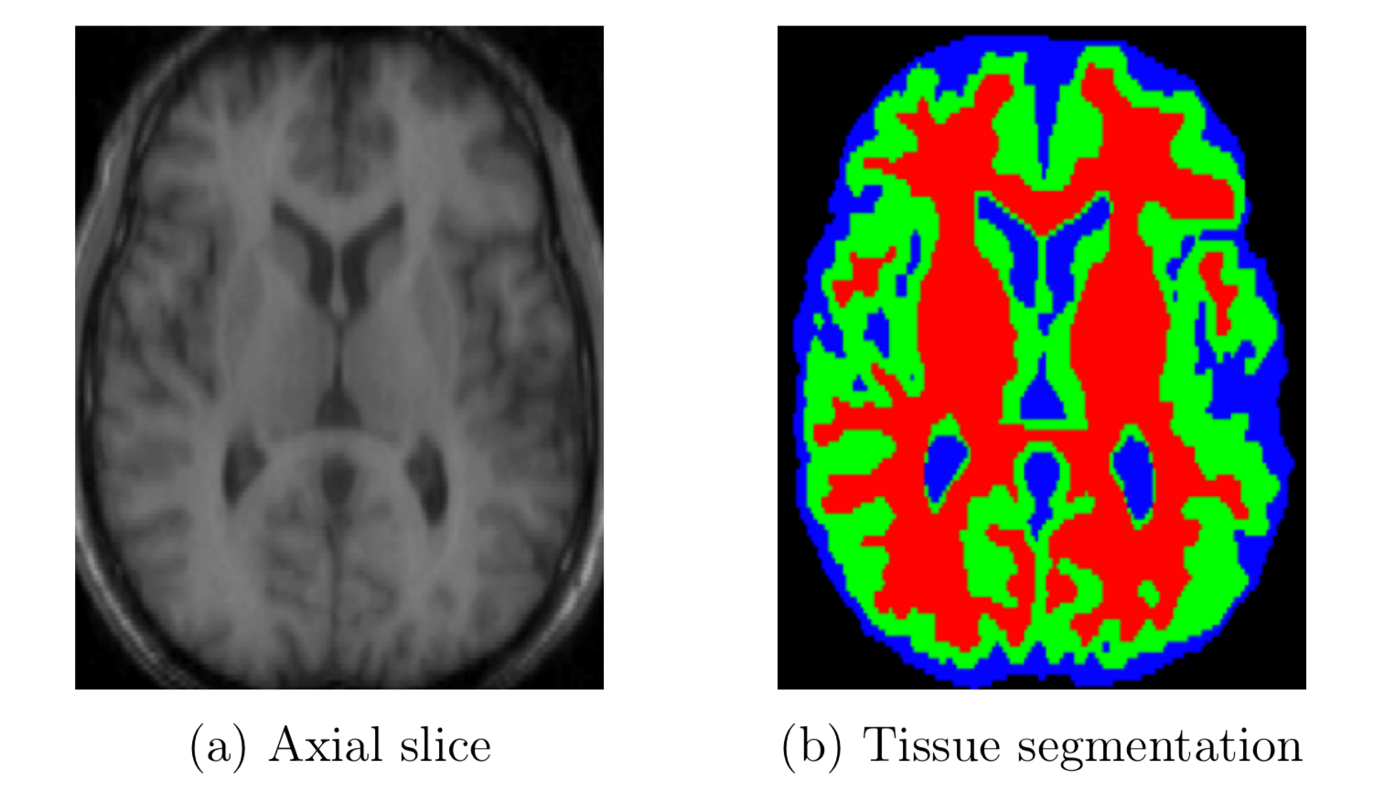 Image Segmentation in Medical Imaging