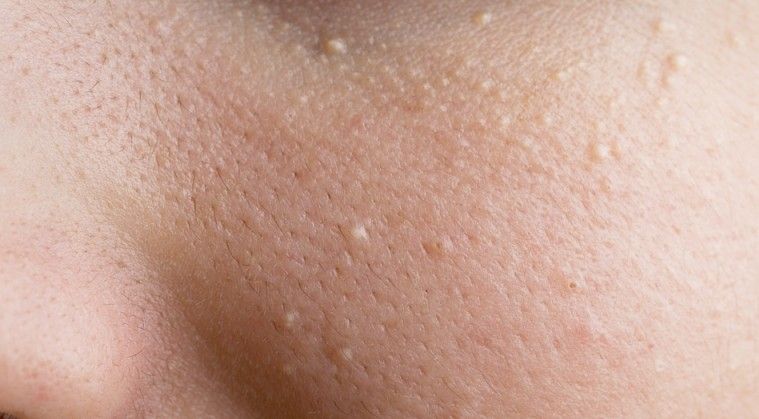 What is that Bump on My Skin?