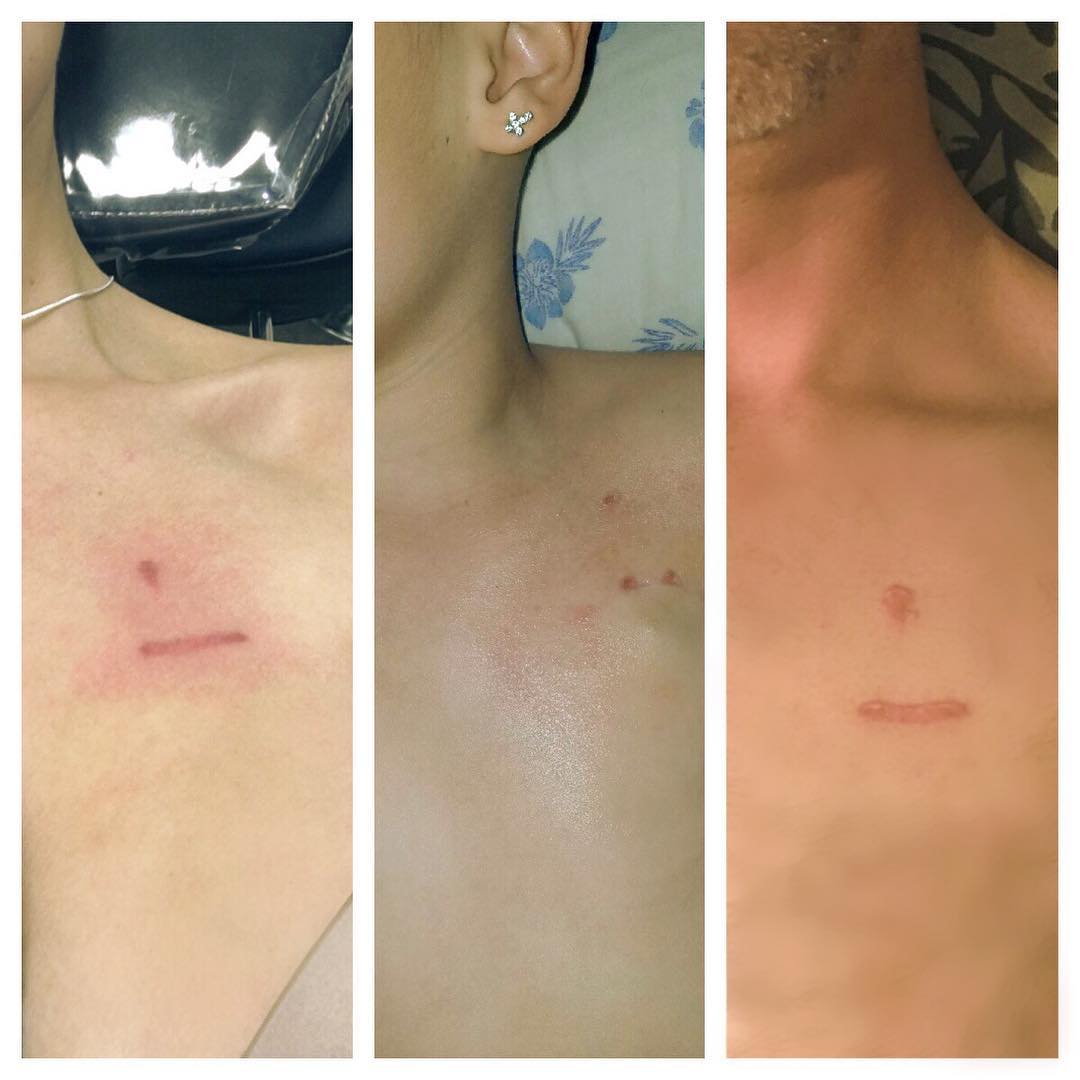 Chemotherapy Port Scar