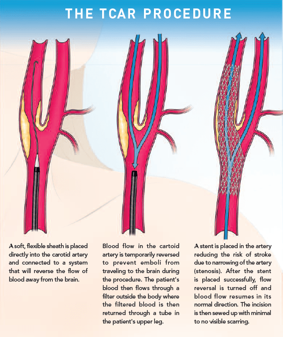 TransCarotid Artery Revascularization St. Clair Health