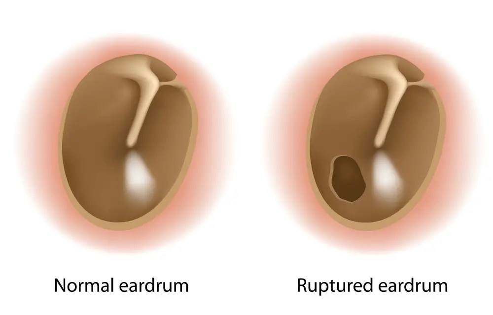 Bleeding From Ear Everything That You Need to Know