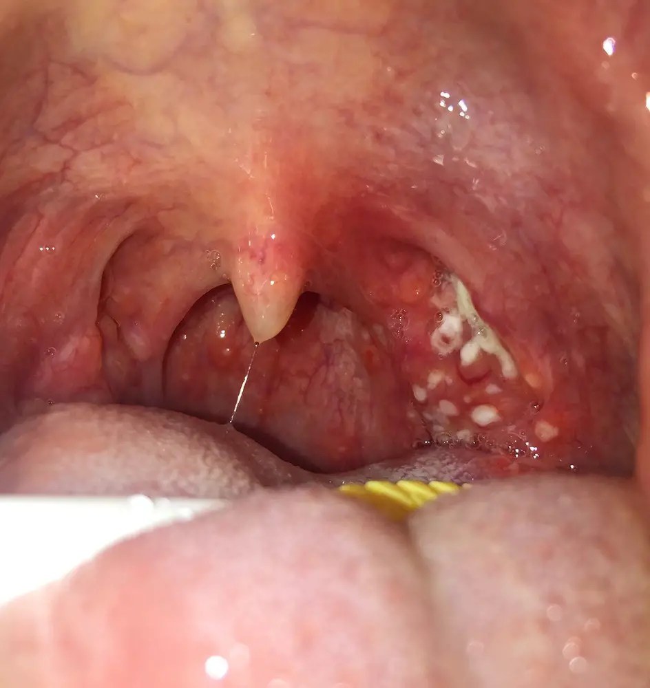 White spots on tonsils causes, symptoms, treatment, pictures