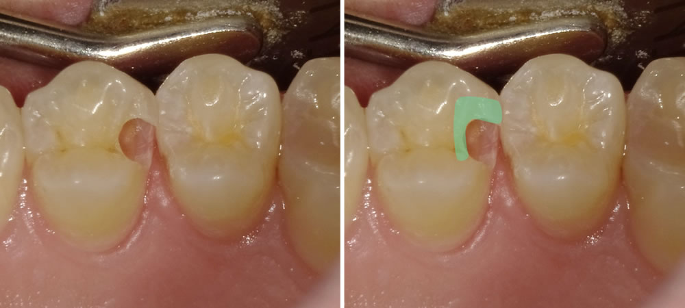CR(コンポジットレジン)修復の症例(20代男性) 市川市の歯医者｜行徳スマイル歯科