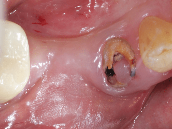 Ridge Augmentation and the Etiology of Buccal Alveolar Resorption SteinerBio
