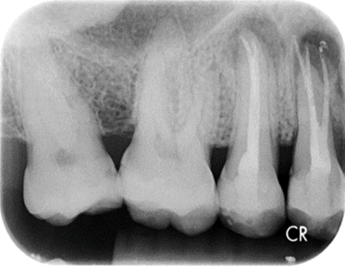 Grafting Endodontic Lesions SteinerBio