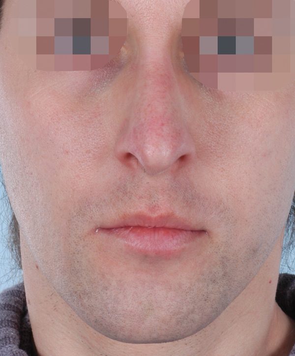 Washington DC Primary Noses Before and After Photos McLean VA Plastic