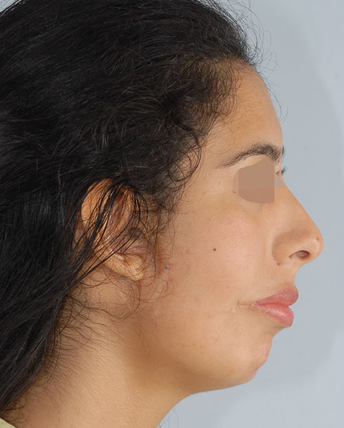 Washington DC Asymmetry and Facial Reshaping Before and After Photos
