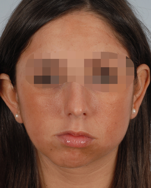 Washington DC Asymmetry and Facial Reshaping Before and After Photos