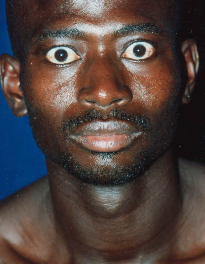 Graves Disease Stepwards