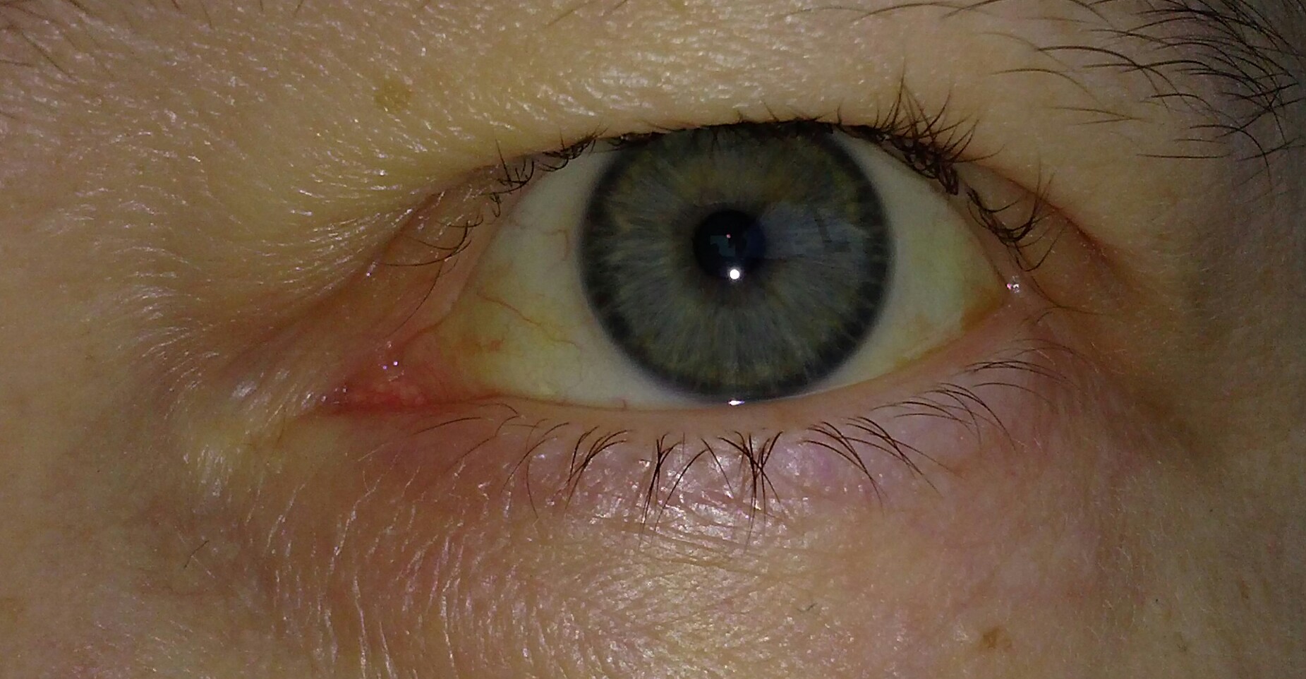 αThalassemia Stepwards