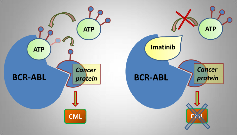 Chronic Myeloid Leukemia/Chronic Myelogenous Leukemia (CML) Stepwards