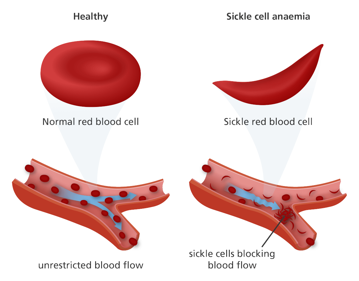 Sickle cell disease Stepwards