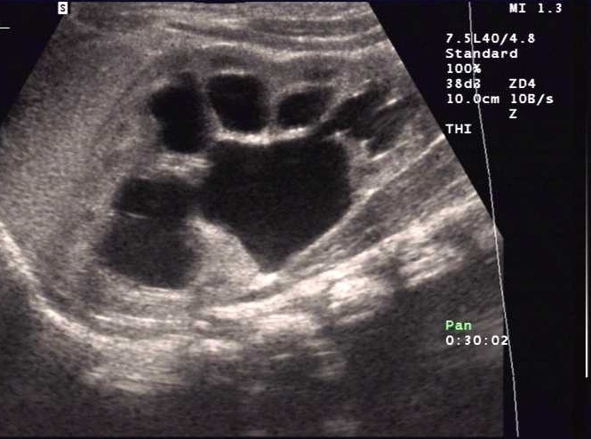 Hydronephrosis Stepwards