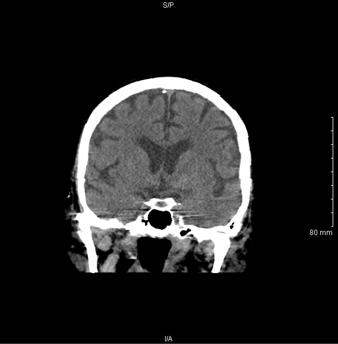 Interpreting A NonContrast Head CT Scan Stepwards