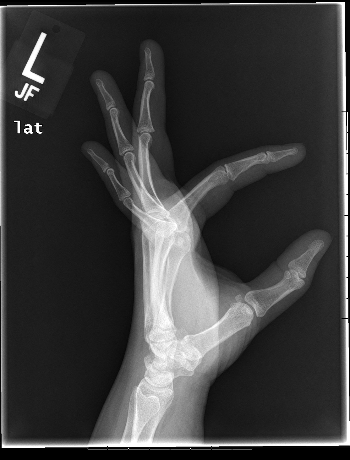 Archive Of Unremarkable Radiological Studies Left Hand XRay Stepwards