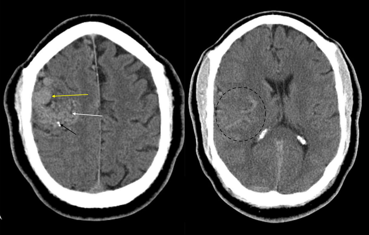 Condition Specific Radiology Cerebral Arteriovenous Malformation