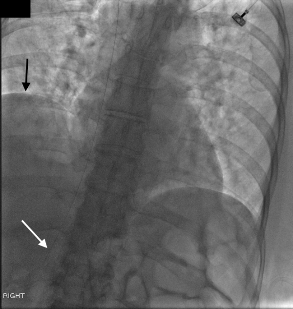 Interventional Radiology Procedures Chest Port Placement Stepwards