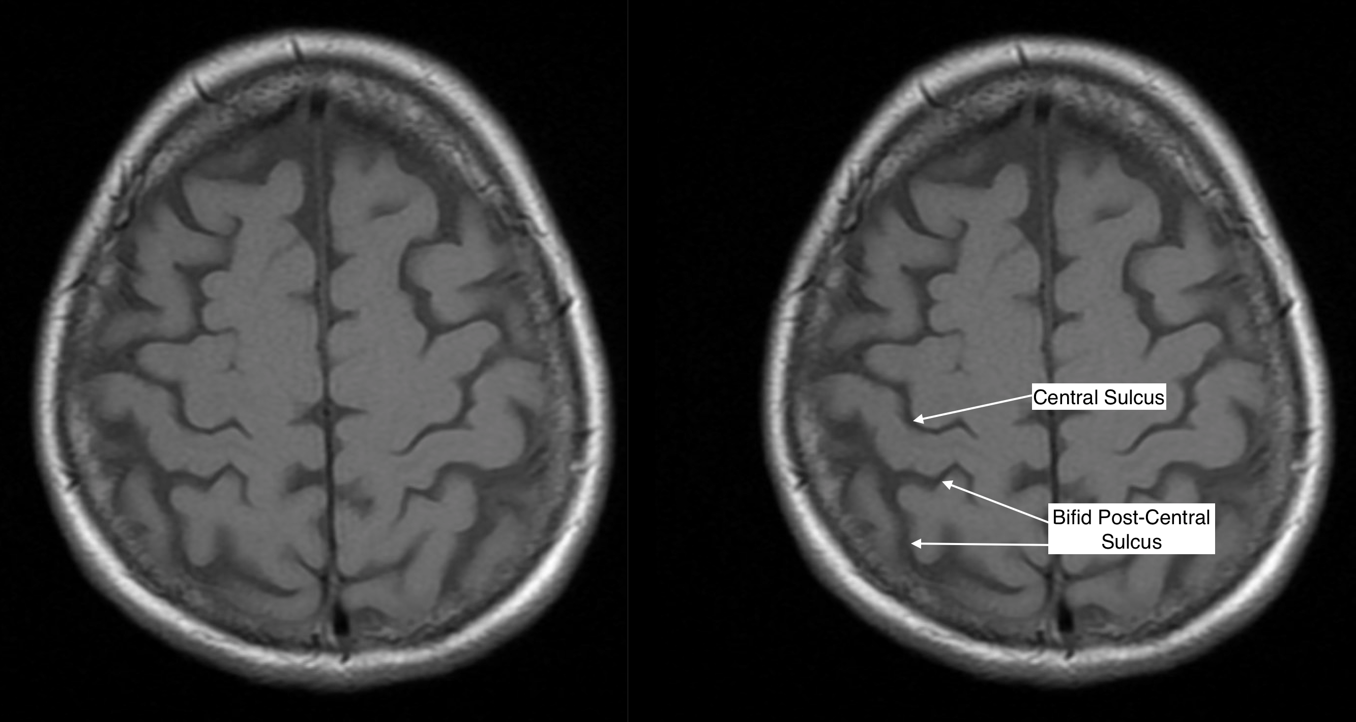 Radiological Anatomy Central Sulcus Stepwards