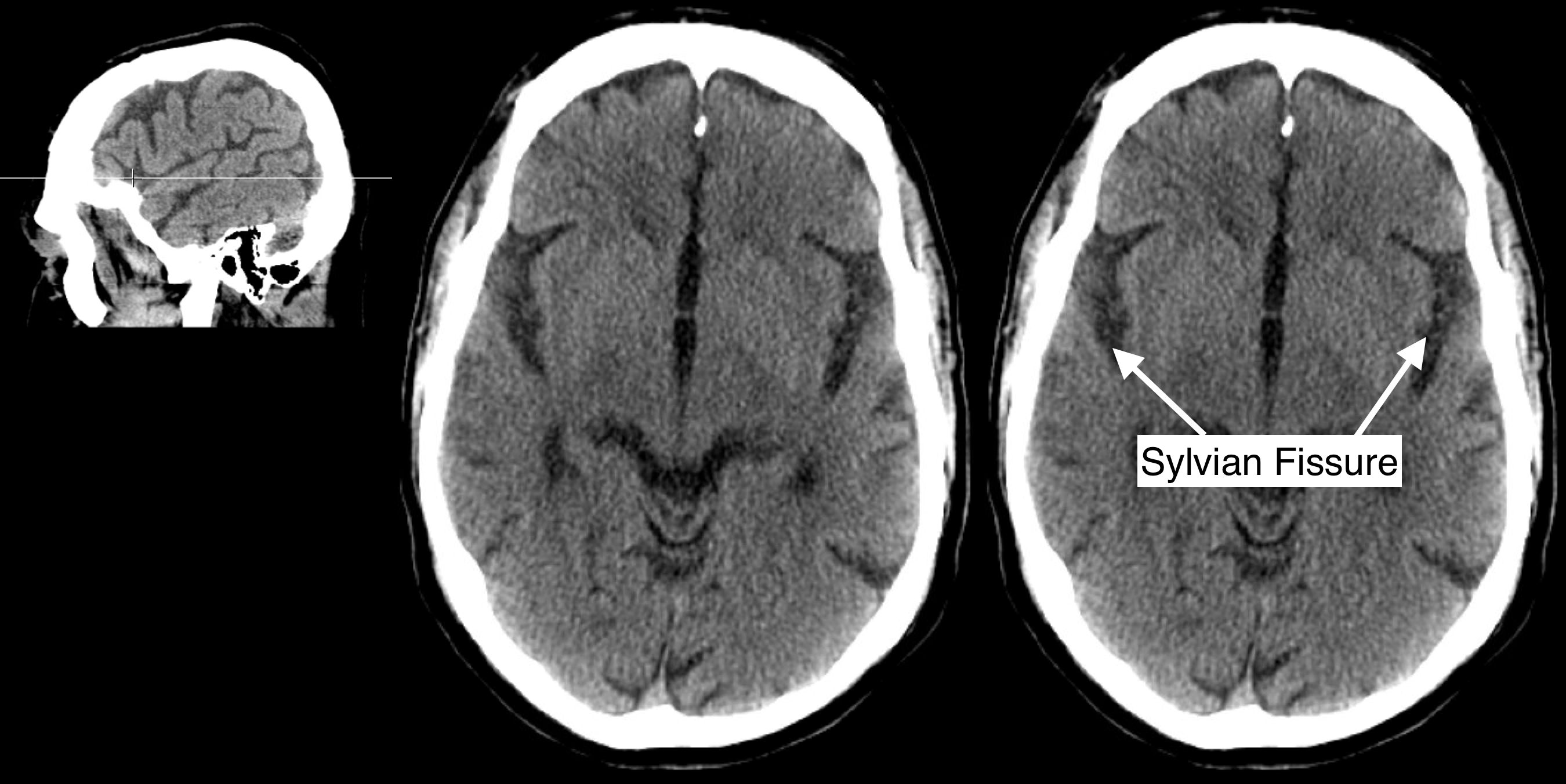 Radiological Anatomy Sylvian Fissure Stepwards