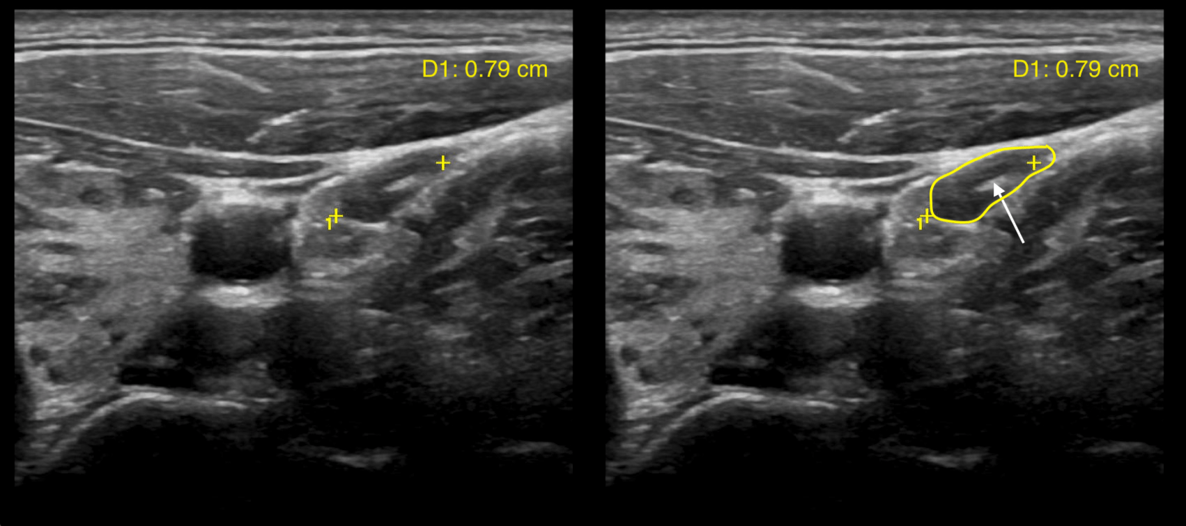 Condition Specific Radiology Hashimoto Thyroiditis Stepwards
