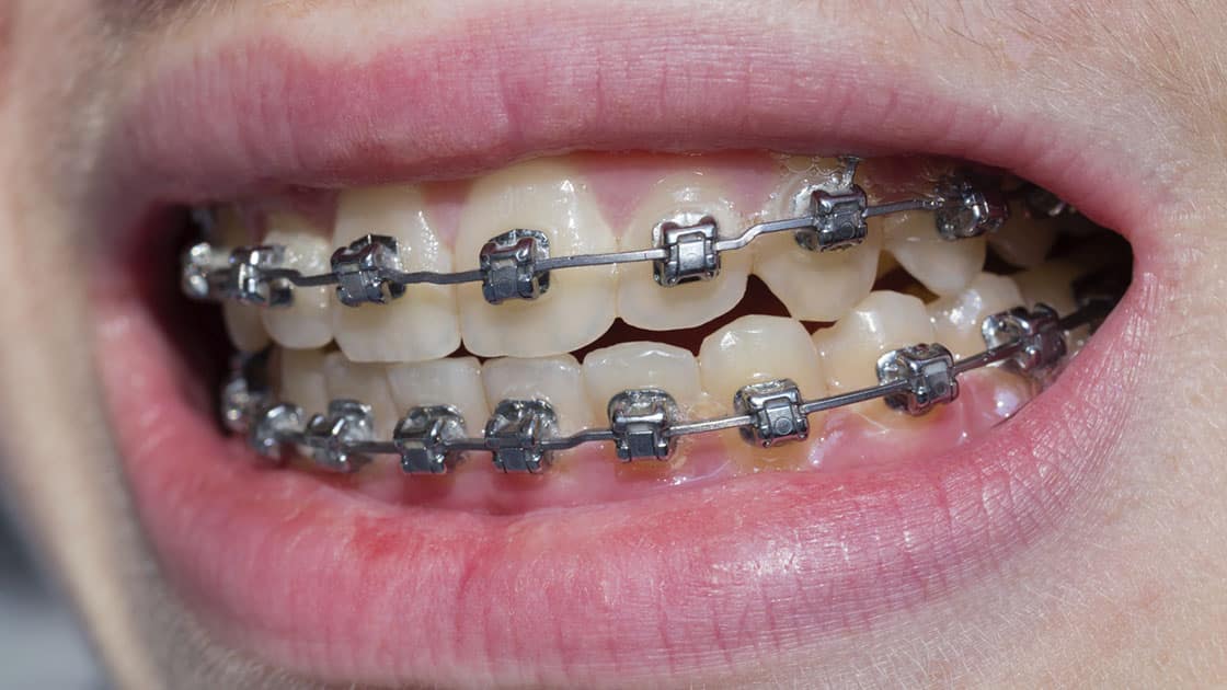 Why Orthodontics – Sterling Endodontics