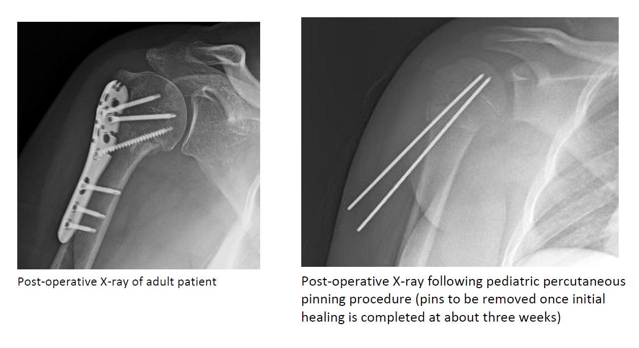 Proximal Humerus Fracture Steven Chudik MD