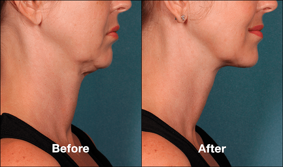 St Louis Kybella Double Chin Treatment St Louis Lipo Center