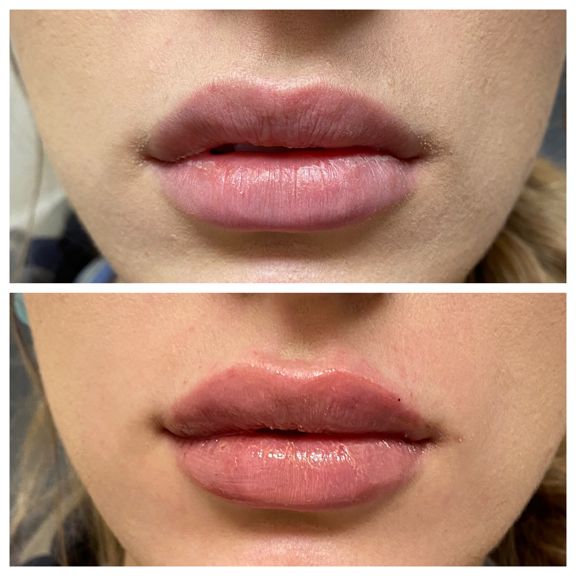 Choosing a Lip Filler Lip Fillers St Louis St Louis Liposuction Center