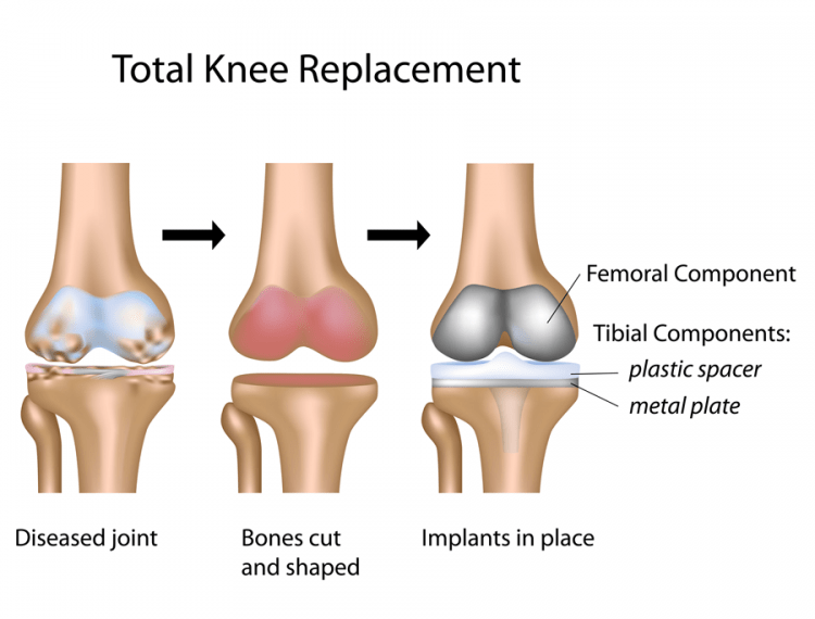 Robotic Knee Replacement Cuttingedge Surgery & Rapid Recovery