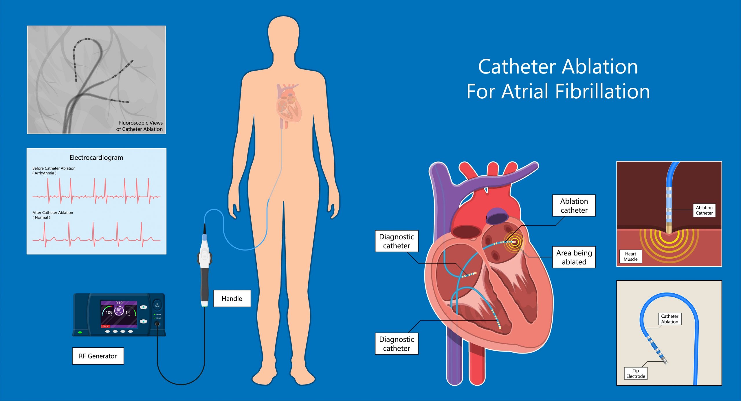 Catheter Ablation for Atrial Fibrillation Overview