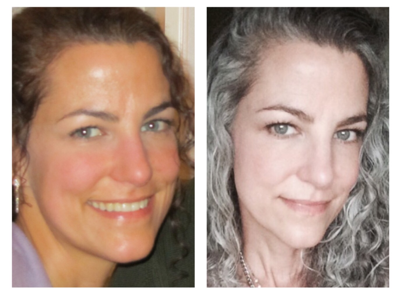 Hypothyroid in photosBefore and After Stop The Thyroid Madness