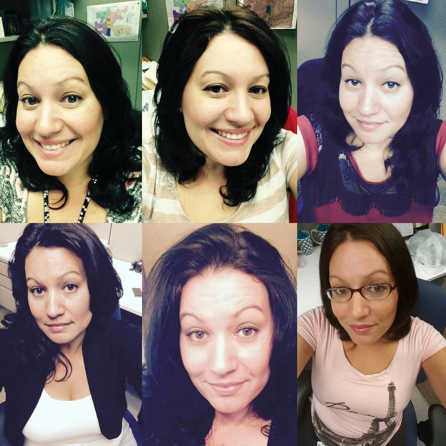 Hypothyroid in photosBefore and After Stop The Thyroid
