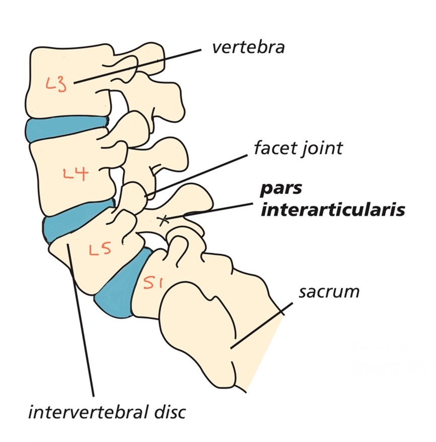 St Peter's College Understanding PARS Syndrome