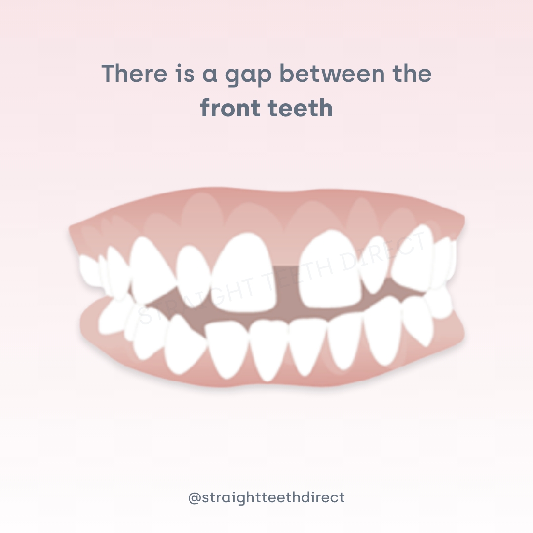 Can Teeth Gaps Be Closed Without Braces Dream Cheeky