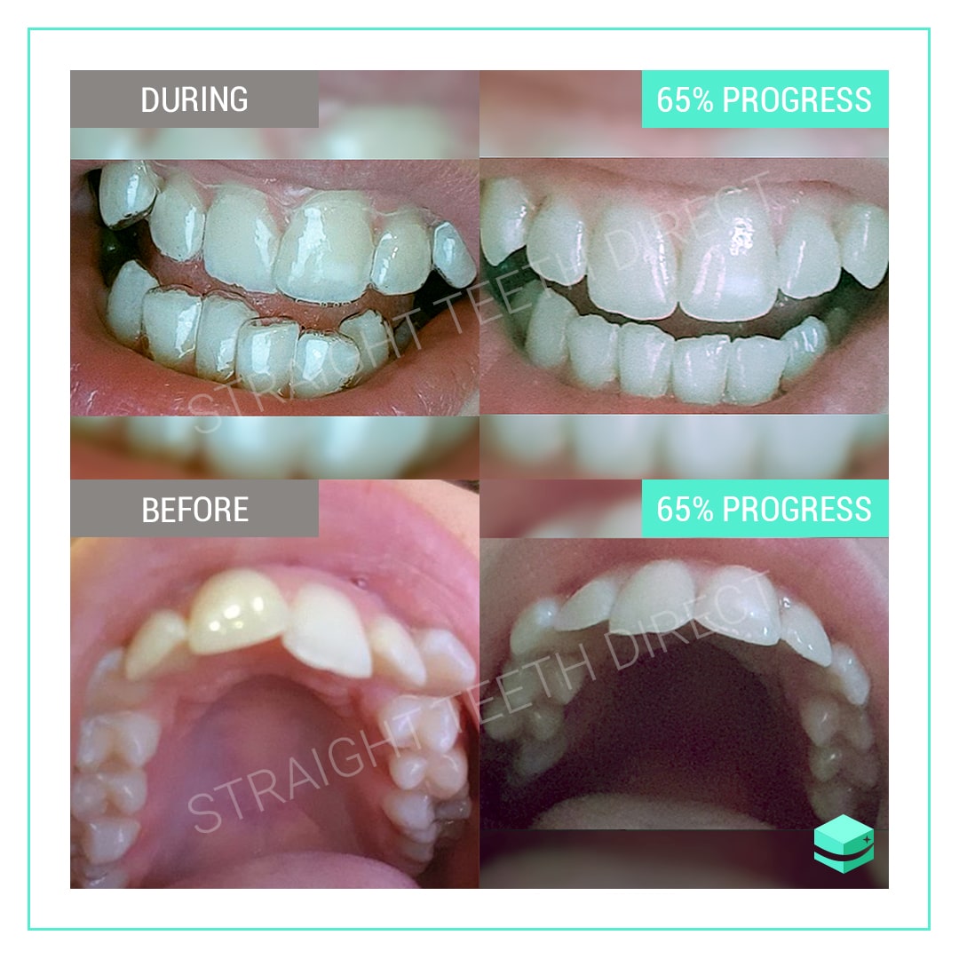 Teeth gaps can they be closed without the use of braces?